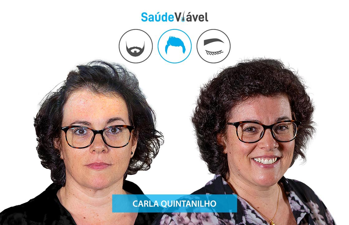 Transplante Capilar Antes e Depois, Carla Quintanilho