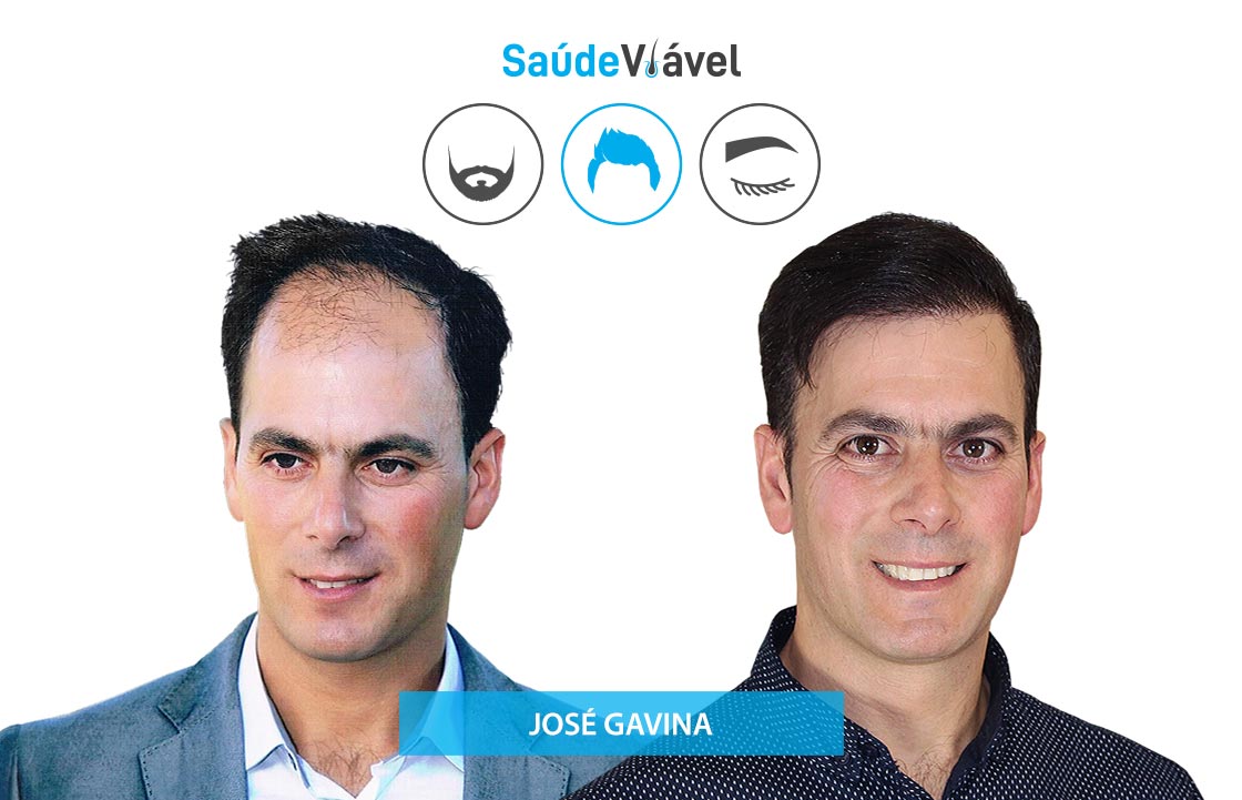 Transplante Capilar Antes e Depois, José Gavina