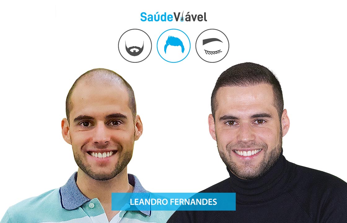 Transplante Capilar Antes e Depois, Leandro Fernandes