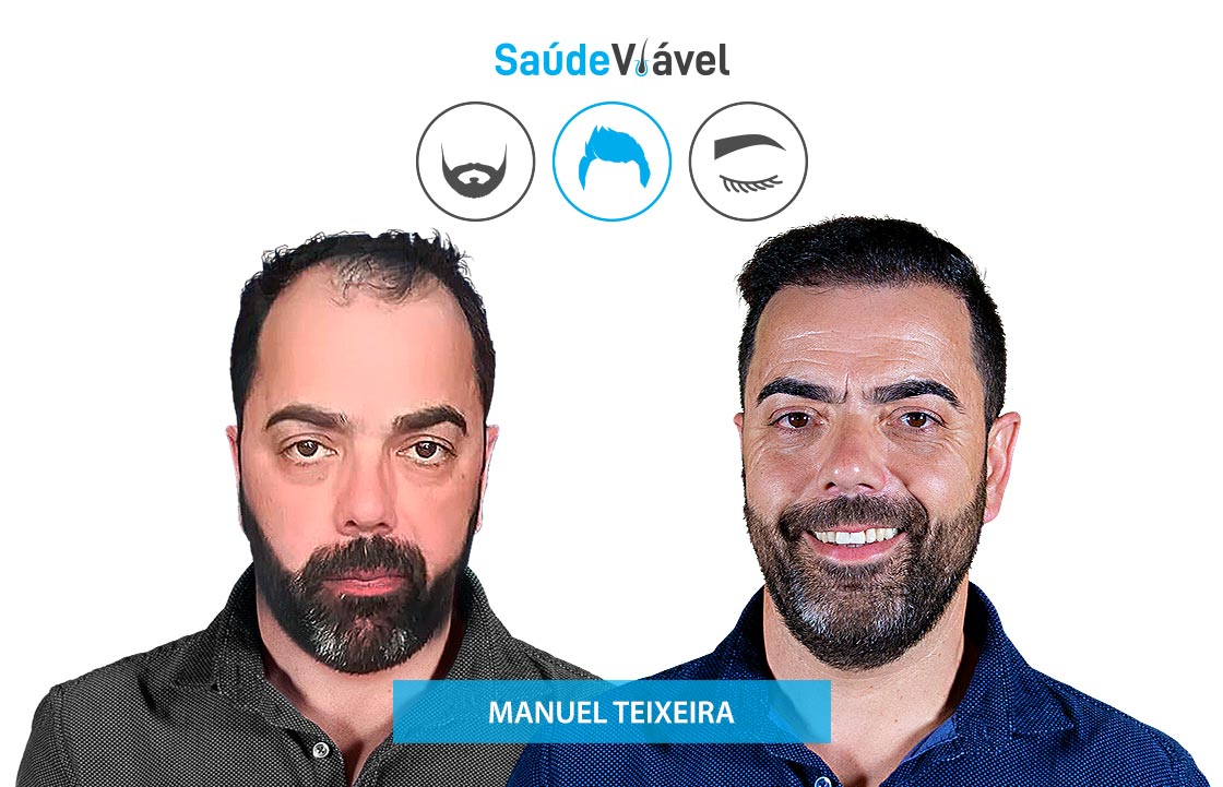 Transplante Capilar Antes e Depois, Manuel Teixeira