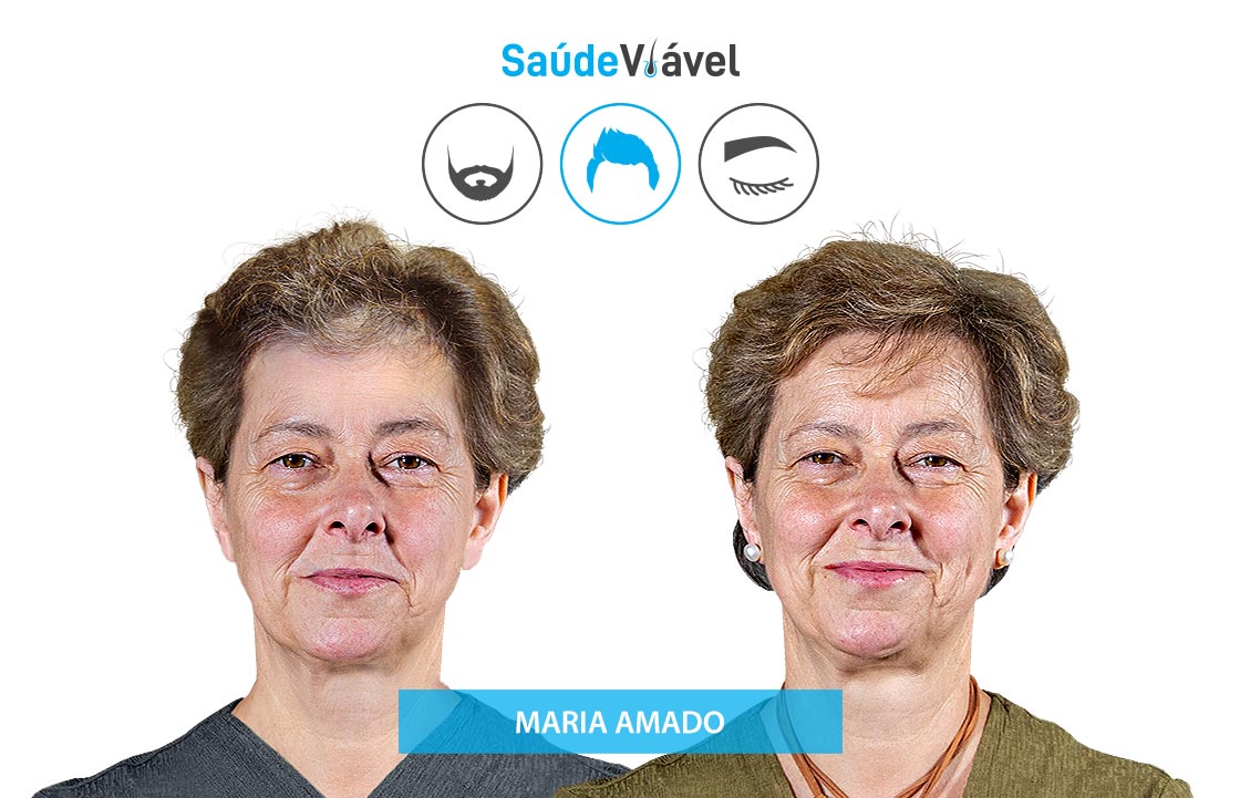 Transplante Capilar Antes e Depois, Maria Amado